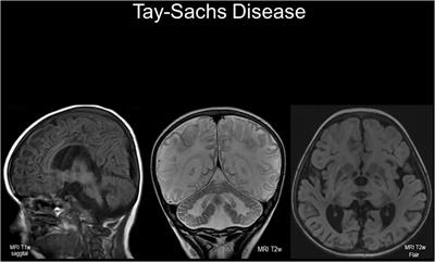 Lysosomal Diseases and Neuropsychiatry: Opportunities to Rebalance the Mind